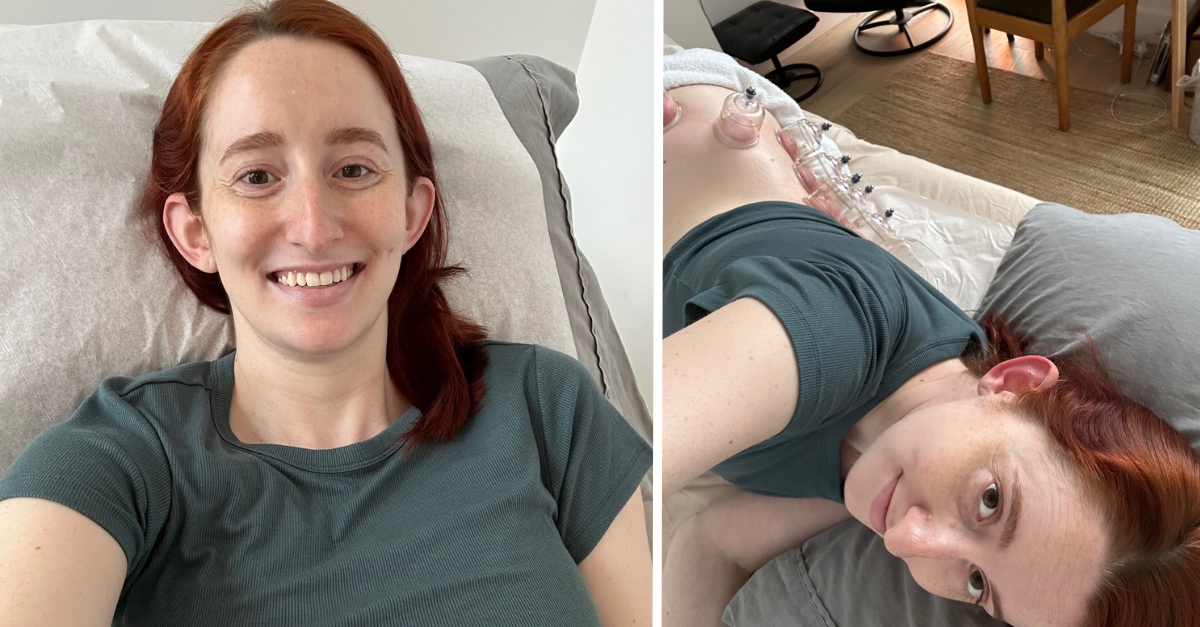 prenatal acupuncture and prenatal cupping